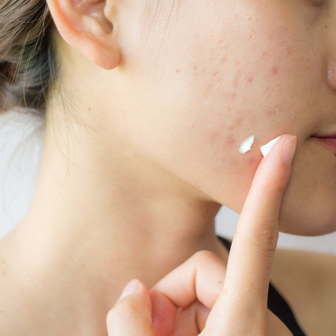 Dermatology Bellingham Dermatology Bellingham